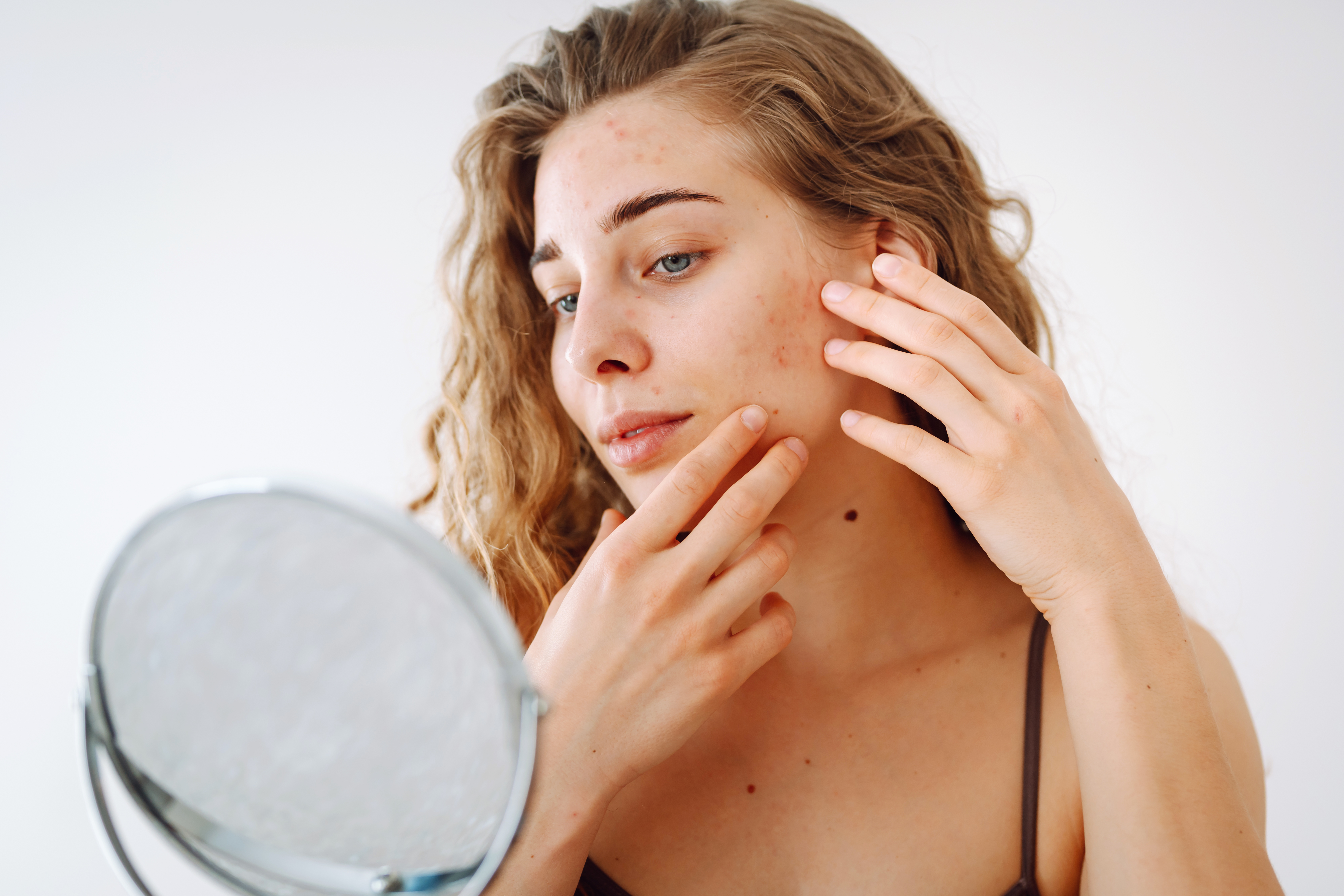 Sivilce İzleri Nasıl Geçer?