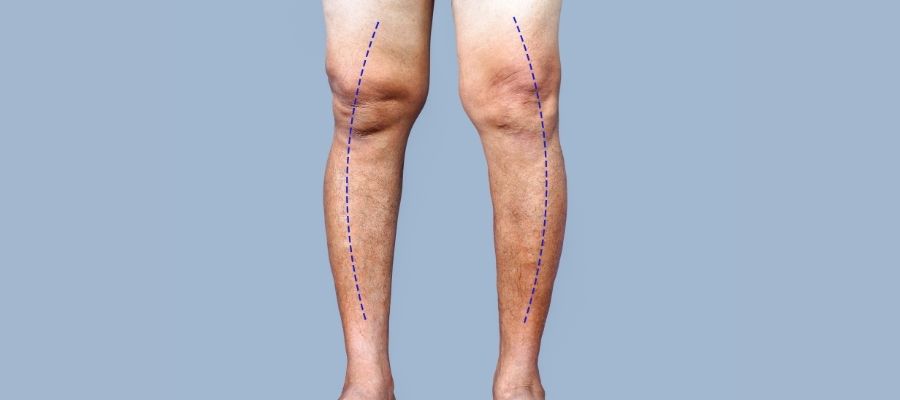 Çarpık Bacak Nedir Genu Varum Belirtileri Nedenleri ve Tedavisi