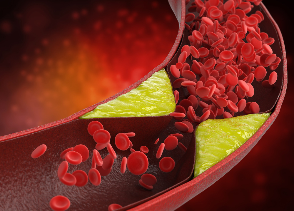 Hiperlipidemi Nedir Yüksek Kolesterol ve Trigliserid Nasıl Düşürülür