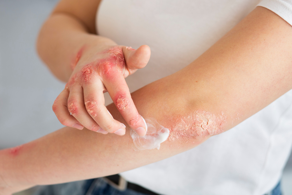 Kontakt Dermatit Nedir Belirtileri Nedenleri ve Tedavi Yaklaşımları